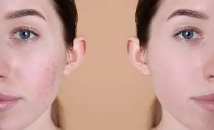How to Remove Acne Scars Using Natural Ingredients