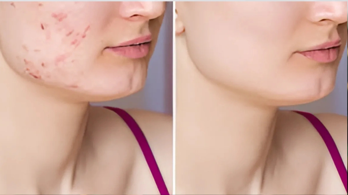 Clear skin the natural way