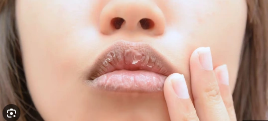 Various Lip Problems and Their Remedies