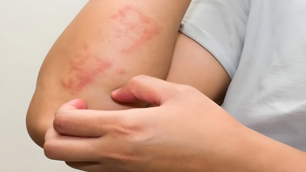 Eat these foods to fight allergies